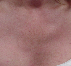 Photorejuvenation for chest - after